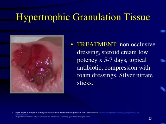 hypertrophic granulation tissue